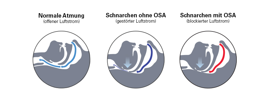 Die Atemwege bei normaler Atmung, bei Schnarchen ohne OSA und Schnarchen mit OSA